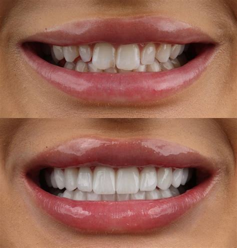 resin veneers|resin veneers before and after.